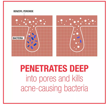 Neutrogena Stubborn Acne Morning Face Treatment with Benzoyl Peroxide - 2.0 oz