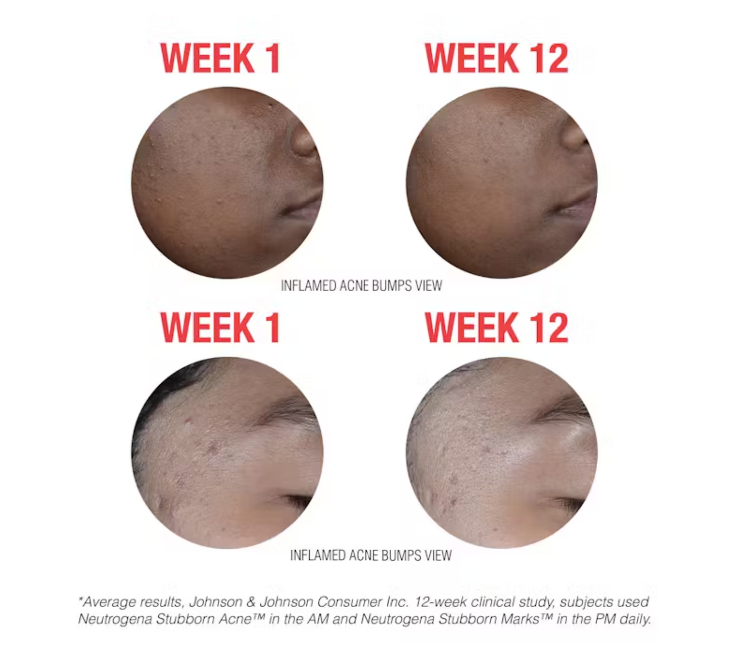 Neutrogena Stubborn Acne Morning Face Treatment with Benzoyl Peroxide - 2.0 oz