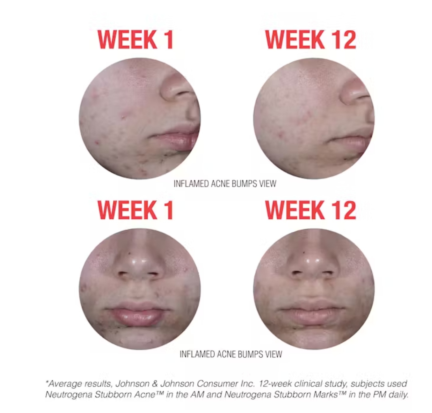 Neutrogena Stubborn Acne Morning Face Treatment with Benzoyl Peroxide - 2.0 oz