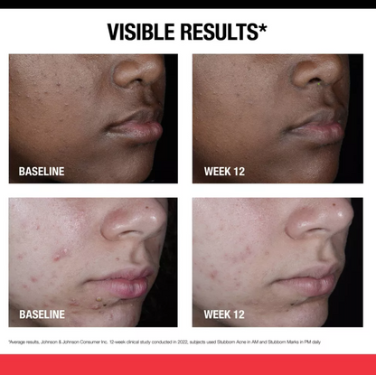 Neutrogena Stubborn Marks Night Treatment Retinol Serum - Fragrance Free - 1.0 fl oz